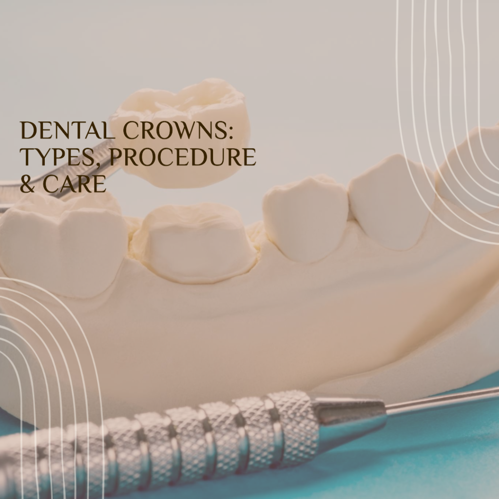 Diagram of dental crown types and the placement procedure